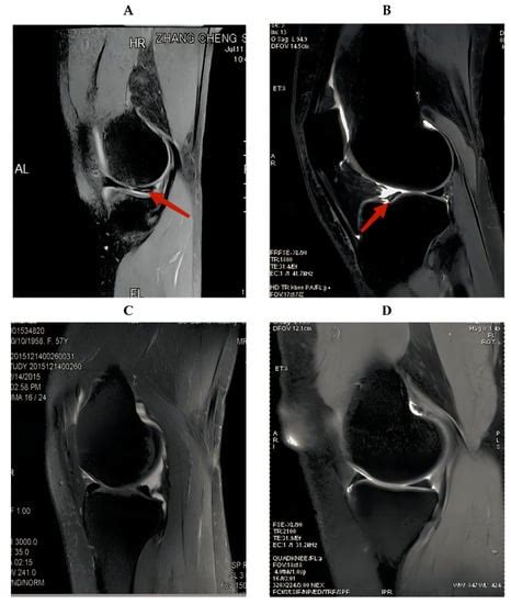 tear of meniscus test|diagnose meniscus tear without mri.